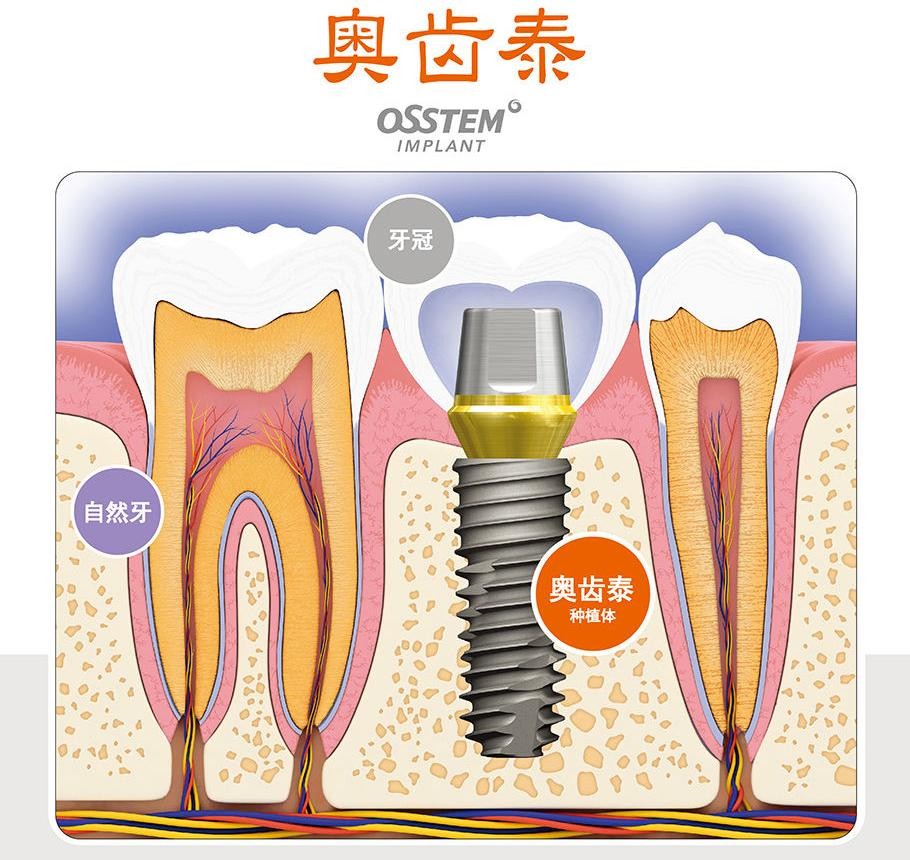 韓國(guó)奧齒泰osstem種植牙