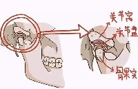 顳下頜關節(jié)疾病