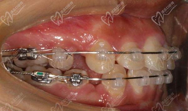 陶瓷半隱形拔牙矯正
