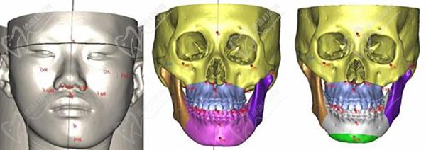 廣州穗華口腔正頜手術(shù)術(shù)前設(shè)計