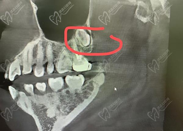 暨大穗華口腔拔除埋伏智齒