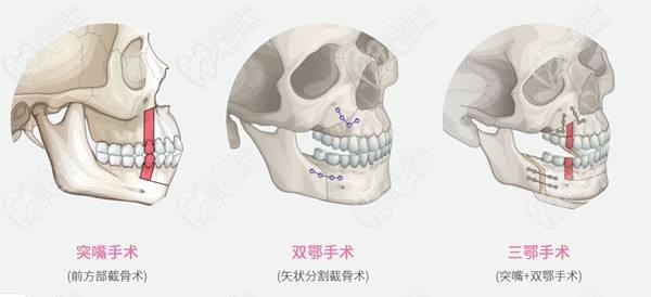 北京正頜手術費用能報銷嗎