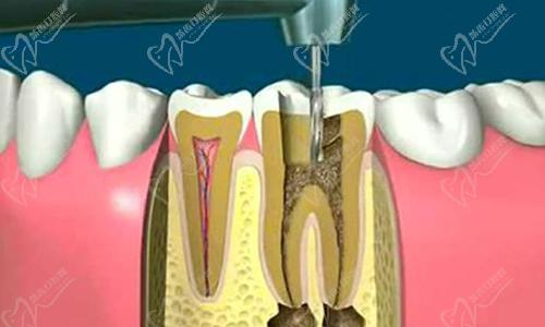 根管治療后隱隱作痛怎么辦？