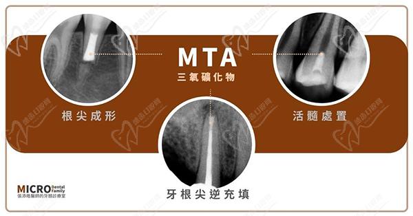 mta口腔材料作用