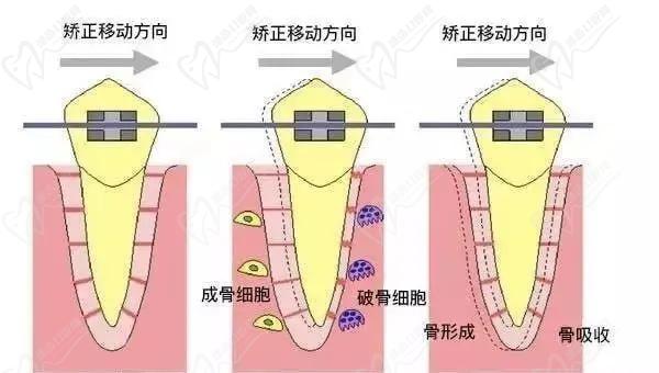 矯正牙根吸收