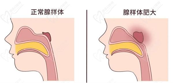 有種丑叫做腺樣體面容