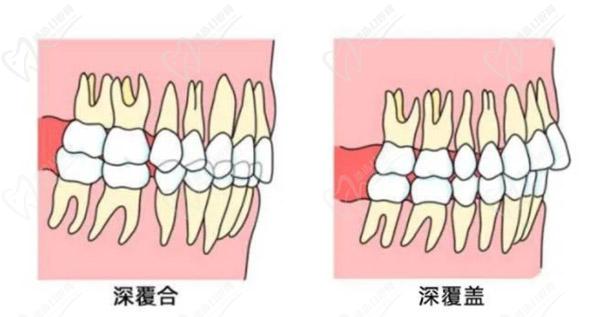 牙齒只深覆蓋正常嗎？深覆蓋有必要矯正嗎？看矯正后臉型變化