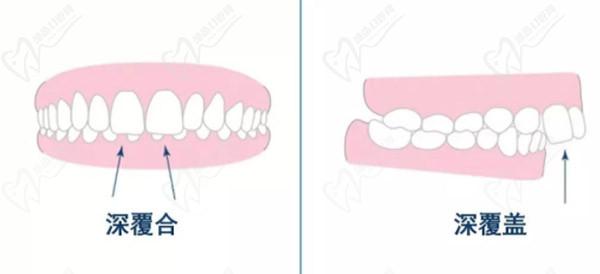 牙齒只深覆蓋正常嗎？深覆蓋有必要矯正嗎？看矯正后臉型變化