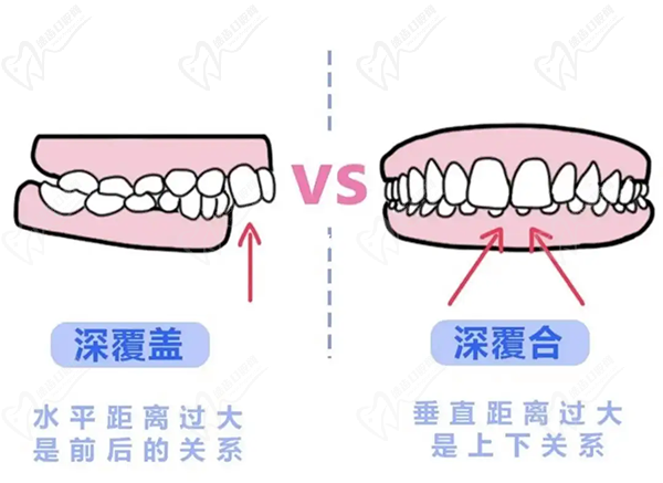 牙齒只深覆蓋正常嗎？深覆蓋有必要矯正嗎？看矯正后臉型變化