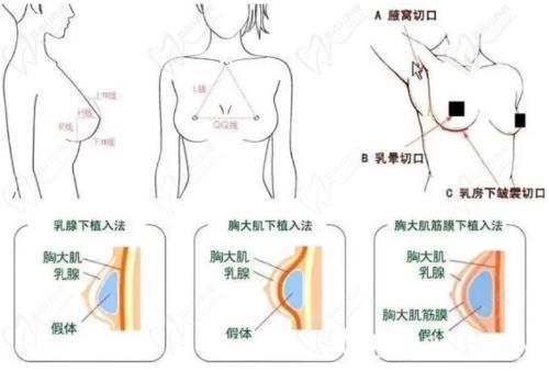 南京夏建軍隆胸手術怎么樣