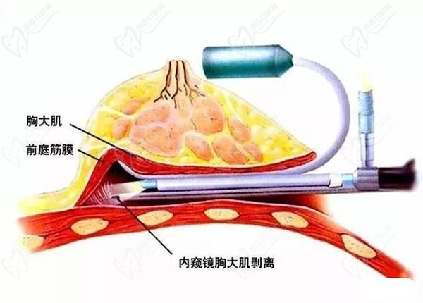 北京隆胸醫(yī)生董巖巖怎么樣