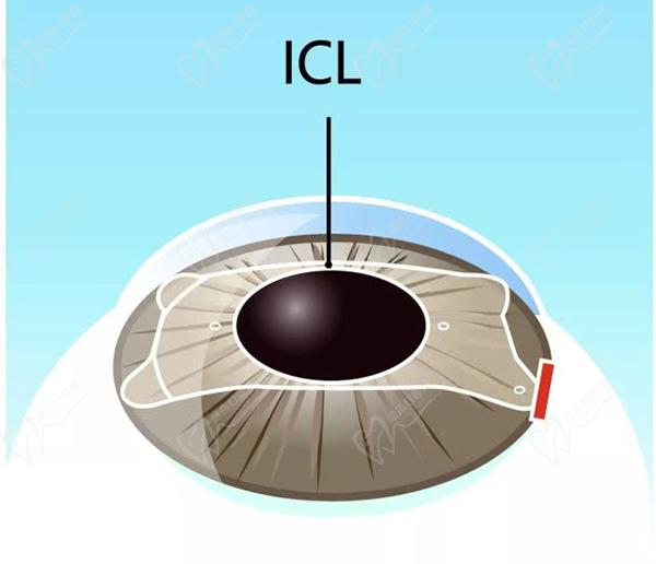 廣州普瑞眼科醫(yī)院ICL晶體植入價(jià)格