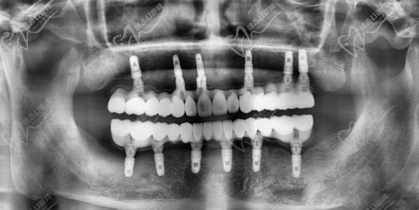 廣州曙光美云口腔醫(yī)院全口種牙怎么樣
