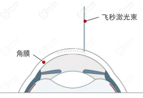 王曉瑛醫(yī)生做近視手術(shù)技術(shù)高超