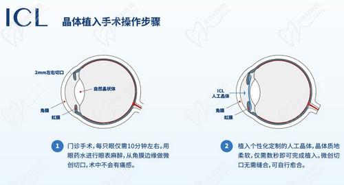 王曉瑛醫(yī)生做ICL晶體植入手術(shù)很出色