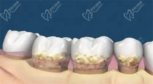 牙結(jié)石掉了是好事還是壞事