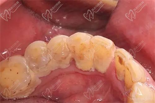 牙結(jié)石掉了