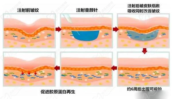 廣州打玻尿酸好的醫(yī)生排名前十