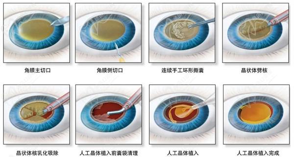 白內(nèi)障手術(shù)