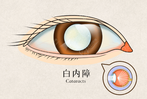 白內(nèi)障