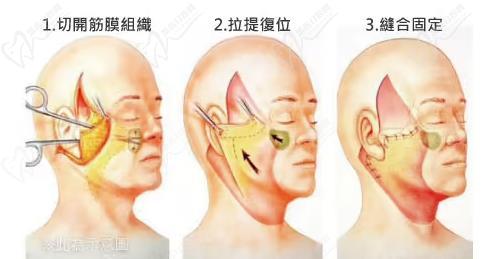 廣州黃廣香擅長什么手術(shù)