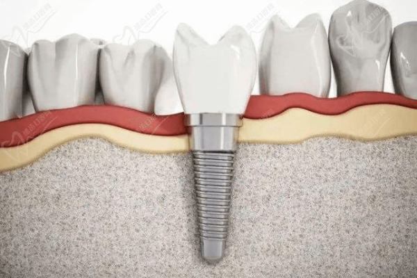 種植牙與傳統(tǒng)鑲牙哪個好？