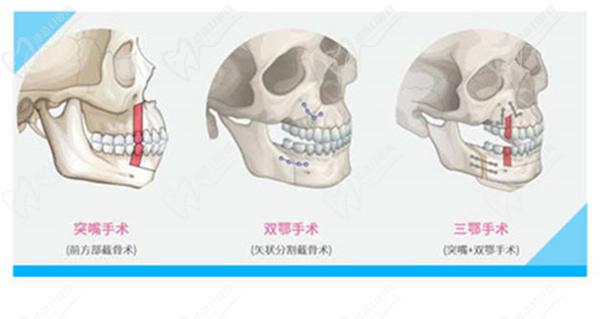 40歲能做正頜手術(shù)嗎