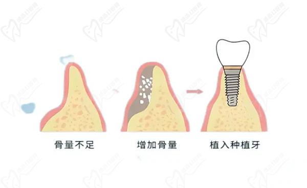 韓國易普萊種植牙怎么樣