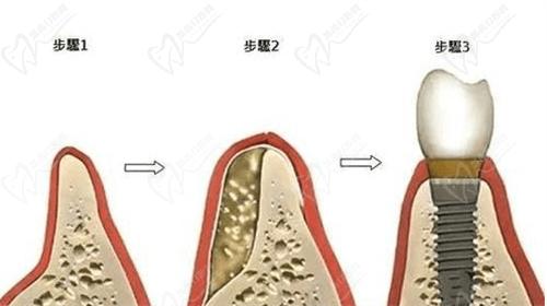 哈爾濱優(yōu)諾口腔在種植牙領(lǐng)域的優(yōu)勢