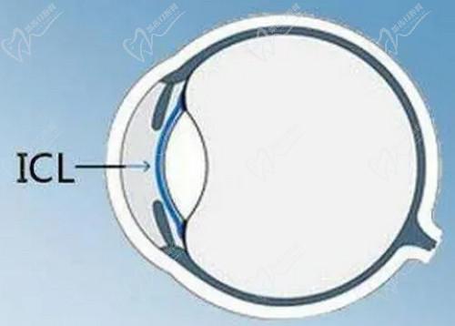 武漢武昌艾格眼科樓永倞ICL晶體植入手術(shù)技術(shù)高超