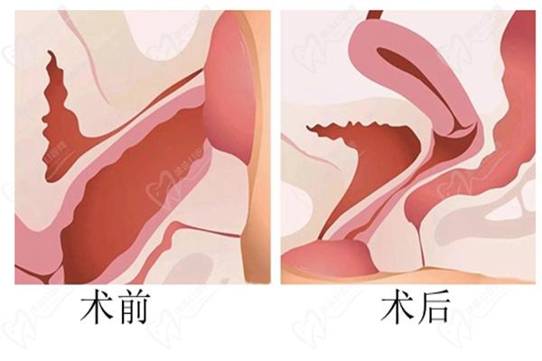 上海九龍醫(yī)院王纓做MEC 3D生物束帶微創(chuàng)緊縮術(shù)怎么樣