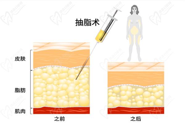 廈門吸脂整形醫(yī)院排名前十多少錢