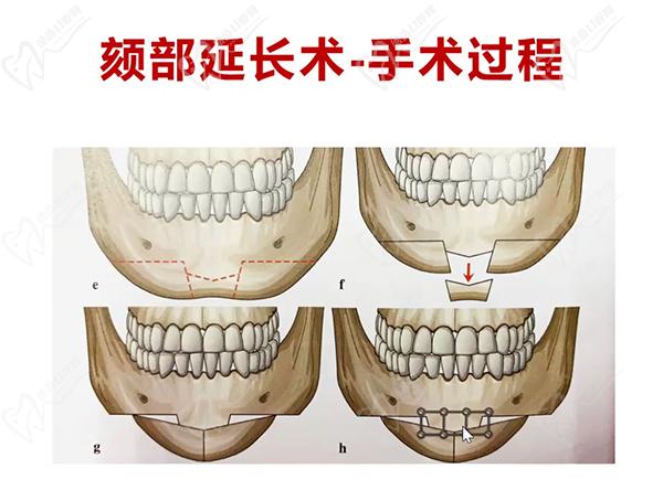 重慶磨骨哪家醫(yī)院好